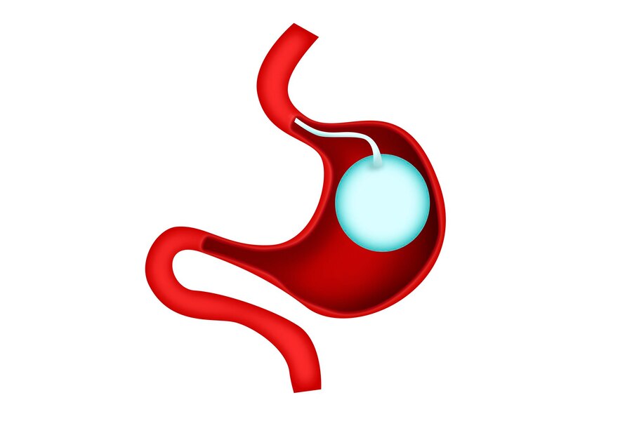 بالون المعدة | المميزات والعيوب